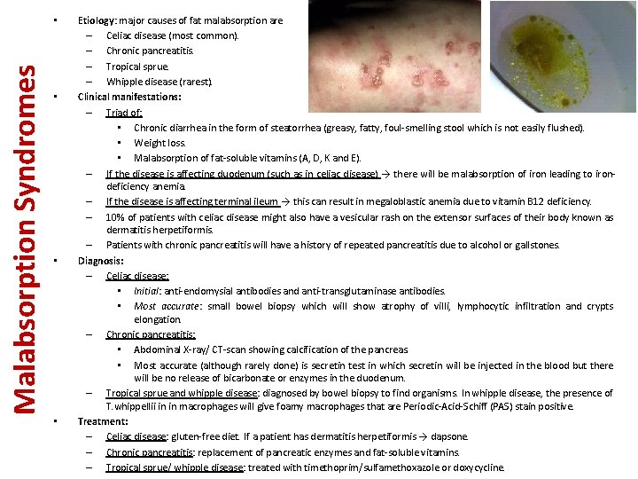 Malabsorption Syndromes • • Etiology: major causes of fat malabsorption are – Celiac disease