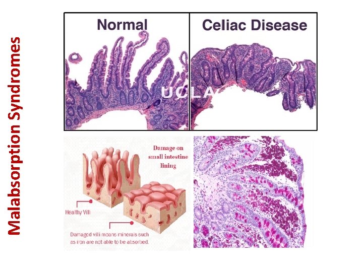 Malabsorption Syndromes 