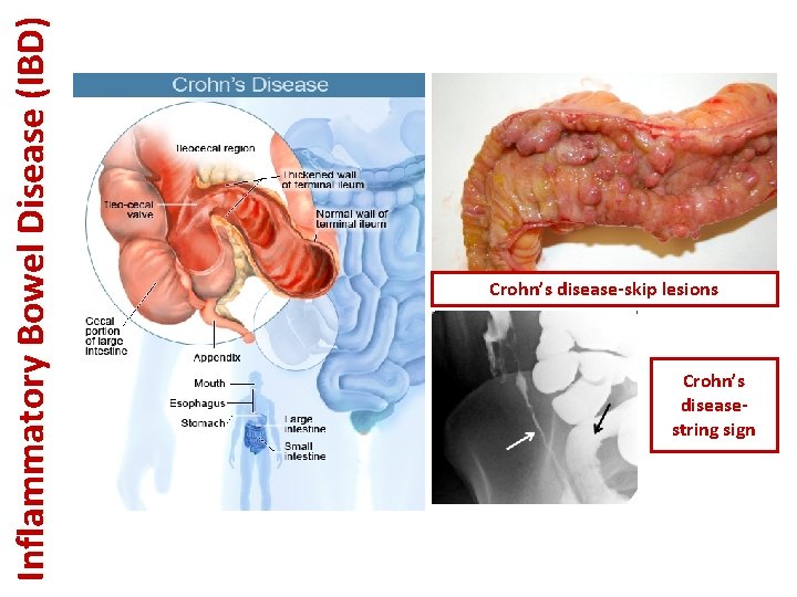 Inflammatory Bowel Disease (IBD) Crohn’s disease-skip lesions Crohn’s diseasestring sign 