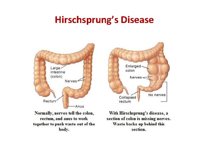 Hirschsprung’s Disease 