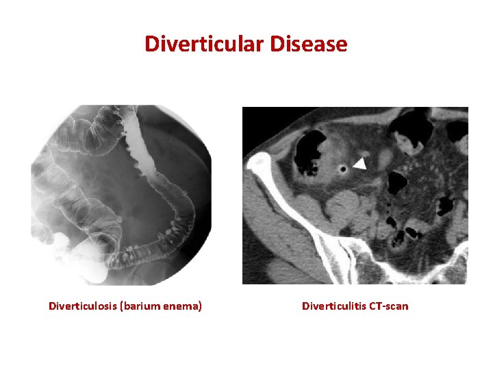 Diverticular Disease Diverticulosis (barium enema) Diverticulitis CT-scan 