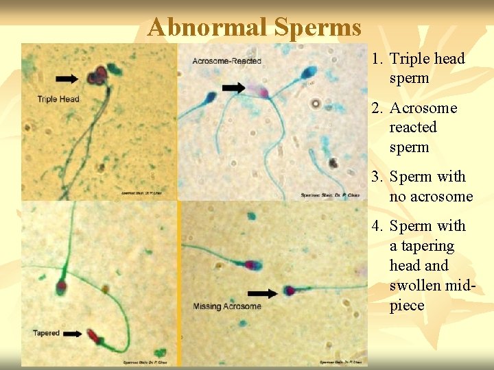 Abnormal Sperms 1. Triple head sperm 2. Acrosome reacted sperm 3. Sperm with no