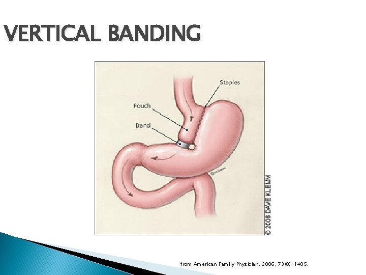 VERTICAL BANDING from American Family Physician, 2006, 73(8): 1405. 