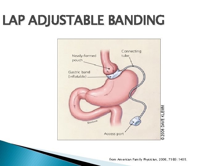 LAP ADJUSTABLE BANDING from American Family Physician, 2006, 73(8): 1405. 