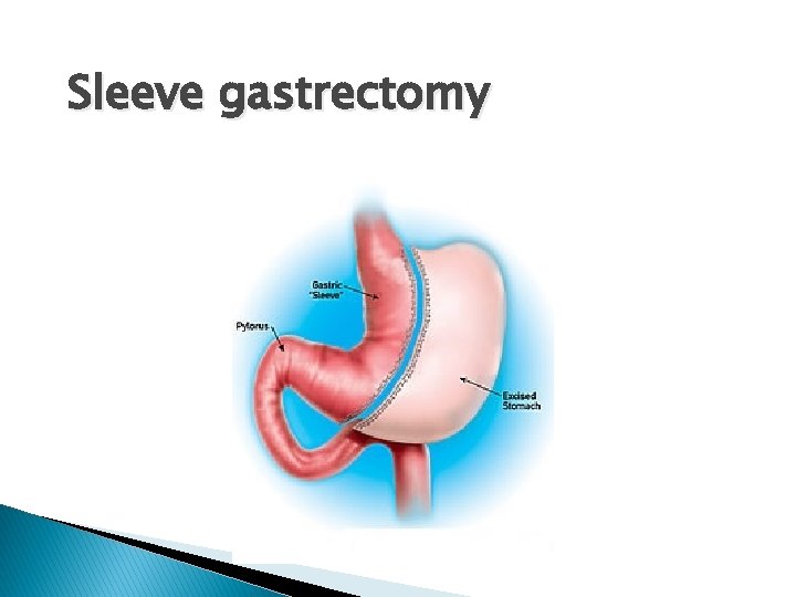 Sleeve gastrectomy 