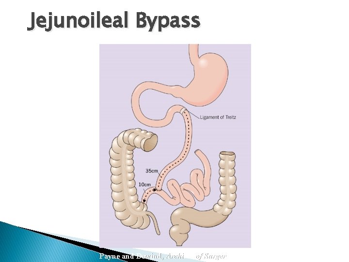 Jejunoileal Bypass Payne and Dewind, Archives of Surgery, 1973 