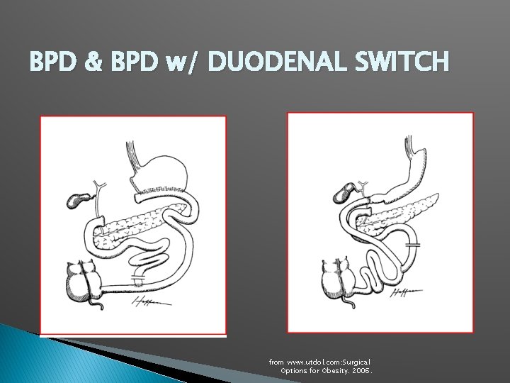 BPD & BPD w/ DUODENAL SWITCH from www. utdol. com: Surgical Options for Obesity.