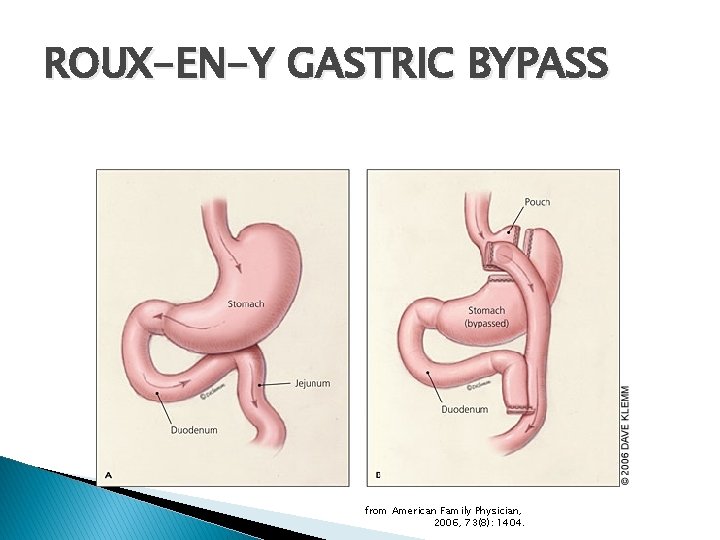 ROUX-EN-Y GASTRIC BYPASS from American Family Physician, 2006, 73(8): 1404. 