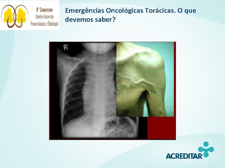 Emergências Oncológicas Torácicas. O que devemos saber? 