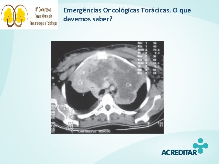 Emergências Oncológicas Torácicas. O que devemos saber? 