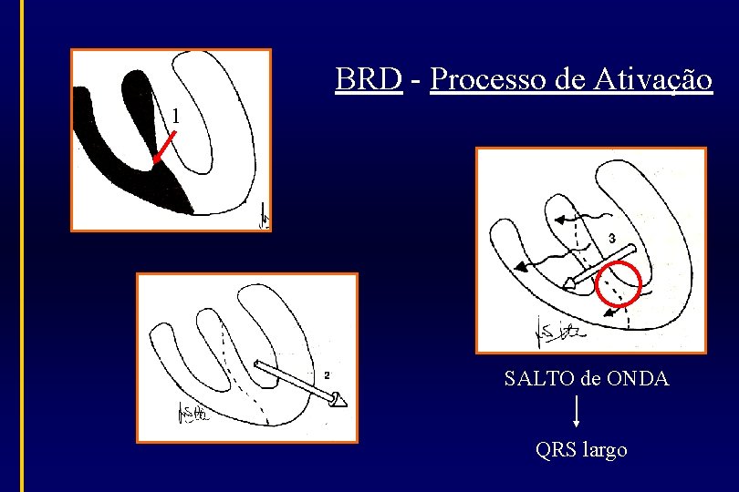 BRD - Processo de Ativação 1 SALTO de ONDA QRS largo 
