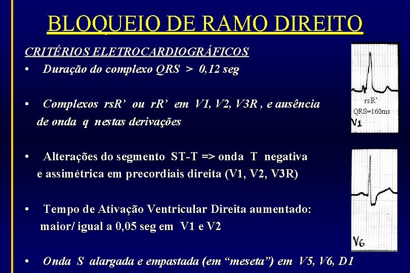 BLOQUEIO DE RAMO DIREITO CRITÉRIOS ELETROCARDIOGRÁFICOS • Duração do complexo QRS > 0, 12