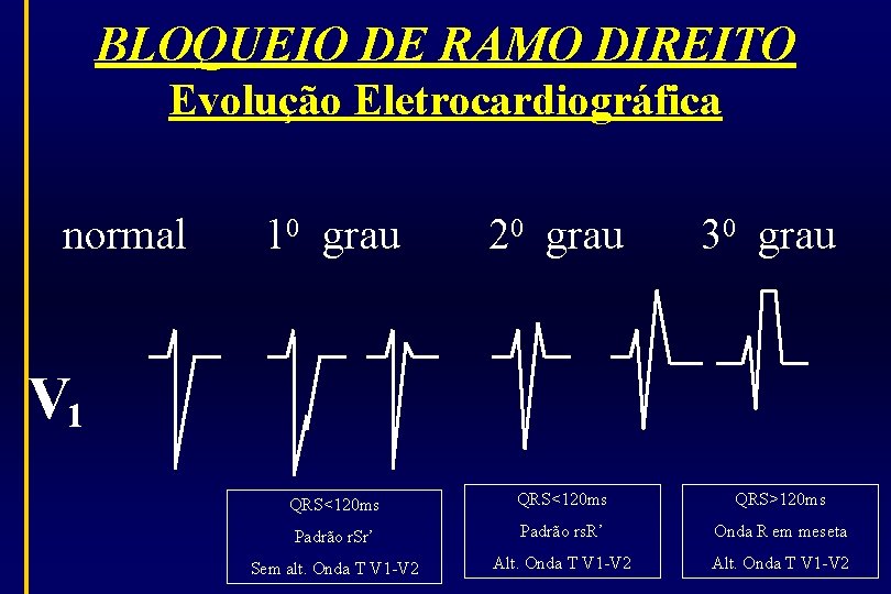BLOQUEIO DE RAMO DIREITO Evolução Eletrocardiográfica normal 10 grau 20 grau 30 grau V