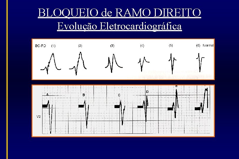 BLOQUEIO de RAMO DIREITO Evolução Eletrocardiográfica 
