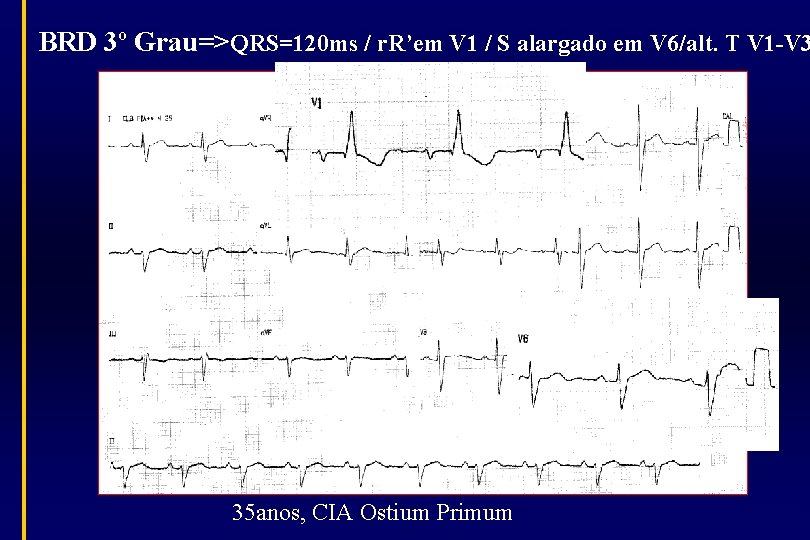 BRD 3º Grau=>QRS=120 ms / r. R’em V 1 / S alargado em V