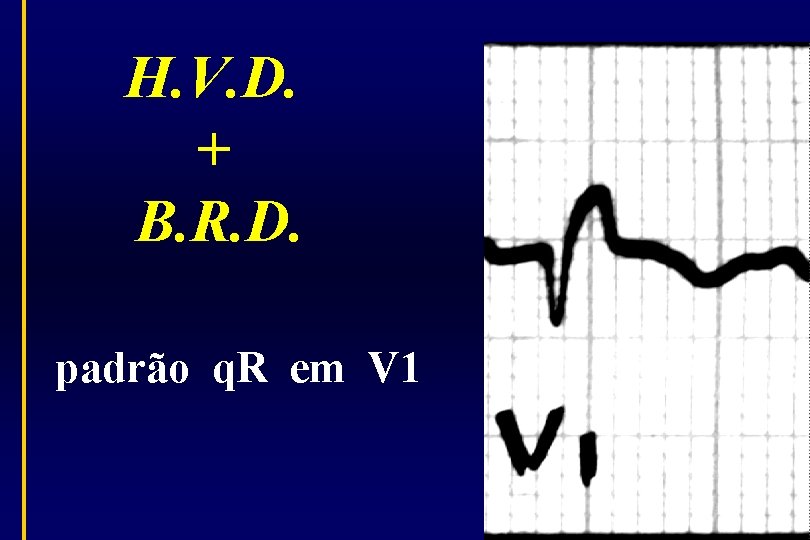H. V. D. + B. R. D. padrão q. R em V 1 