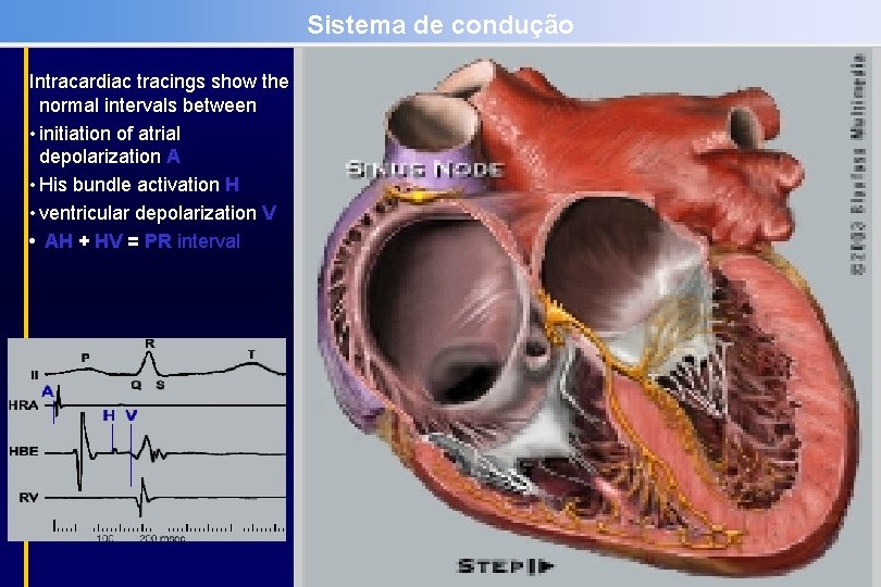 Sistema de condução Intracardiac tracings show the normal intervals between • initiation of atrial