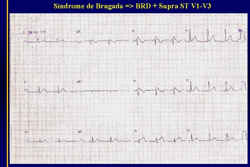 Síndrome de Brugada => BRD + Supra ST V 1 -V 3 