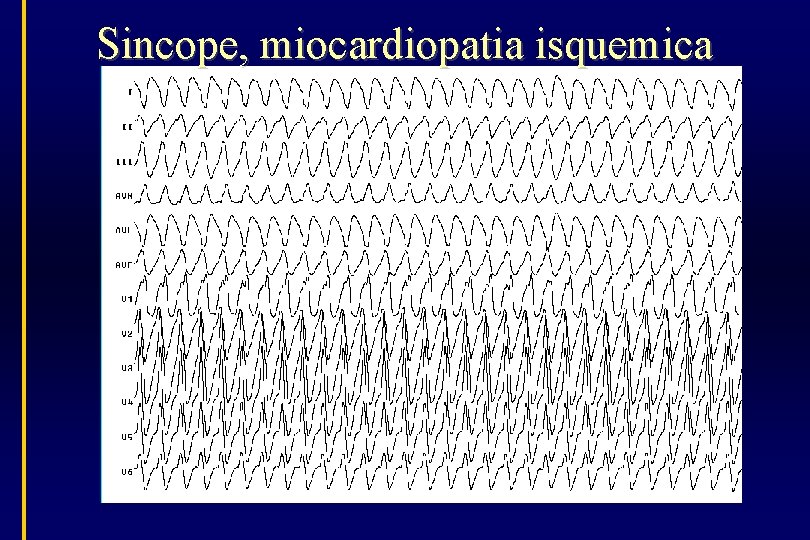 Sincope, miocardiopatia isquemica 