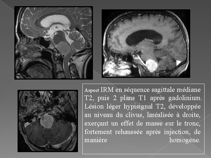 Aspect IRM en séquence sagittale médiane T 2, puis 2 plans T 1 après