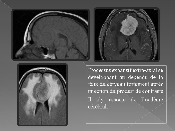 Processus expansif extra-axial se développant au dépends de la faux du cerveau fortement après