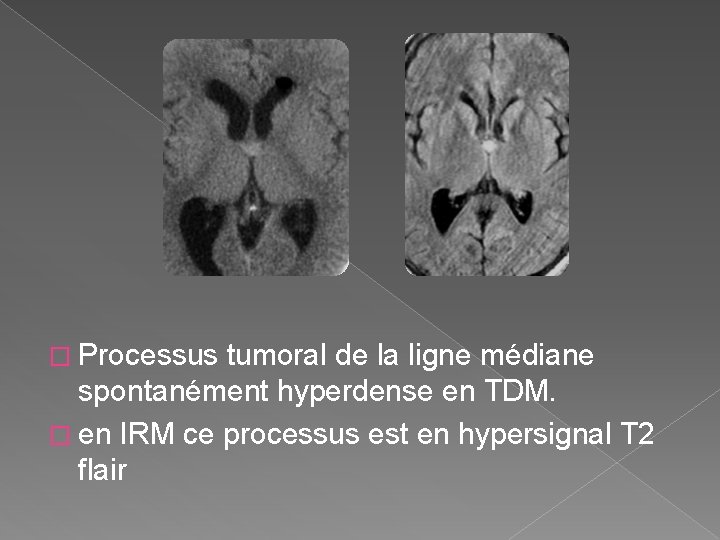 � Processus tumoral de la ligne médiane spontanément hyperdense en TDM. � en IRM