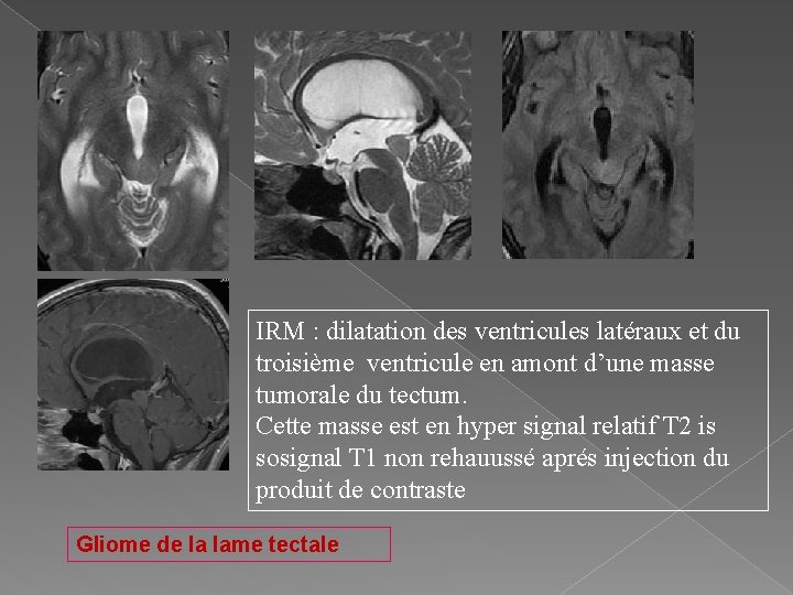 IRM : dilatation des ventricules latéraux et du troisième ventricule en amont d’une masse