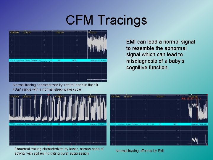 CFM Tracings EMI can lead a normal signal to resemble the abnormal signal which