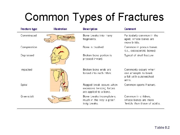 Common Types of Fractures Table 5. 2 