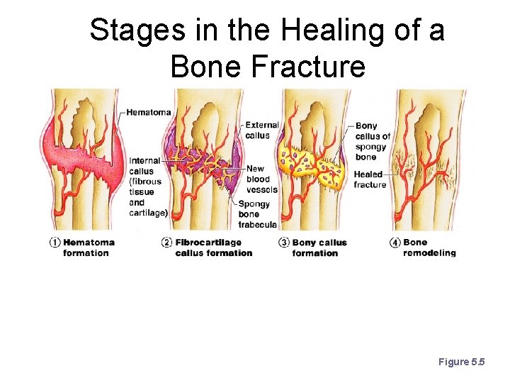 Stages in the Healing of a Bone Fracture Figure 5. 5 