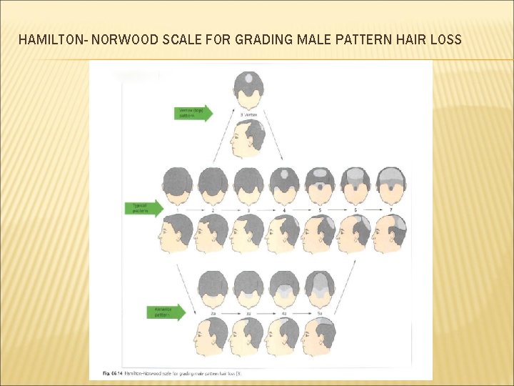 HAMILTON- NORWOOD SCALE FOR GRADING MALE PATTERN HAIR LOSS 