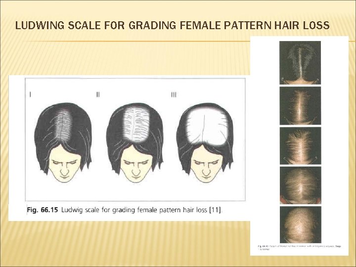LUDWING SCALE FOR GRADING FEMALE PATTERN HAIR LOSS 