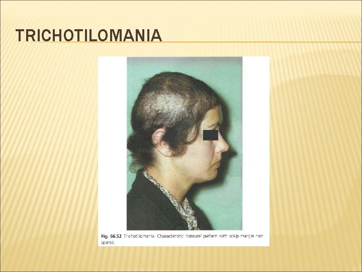 TRICHOTILOMANIA 