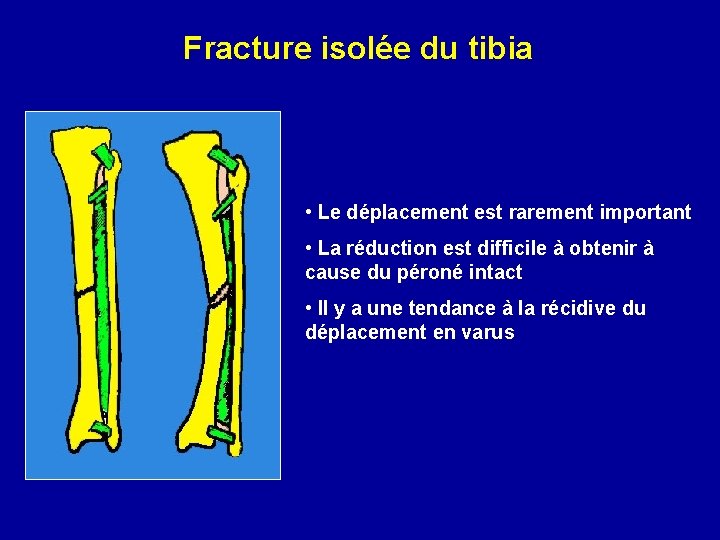 Fracture isolée du tibia • Le déplacement est rarement important • La réduction est