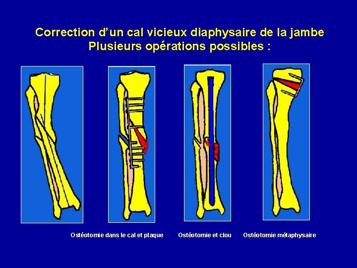 Correction d’un cal vicieux diaphysaire de la jambe Plusieurs opérations possibles : Ostéotomie dans