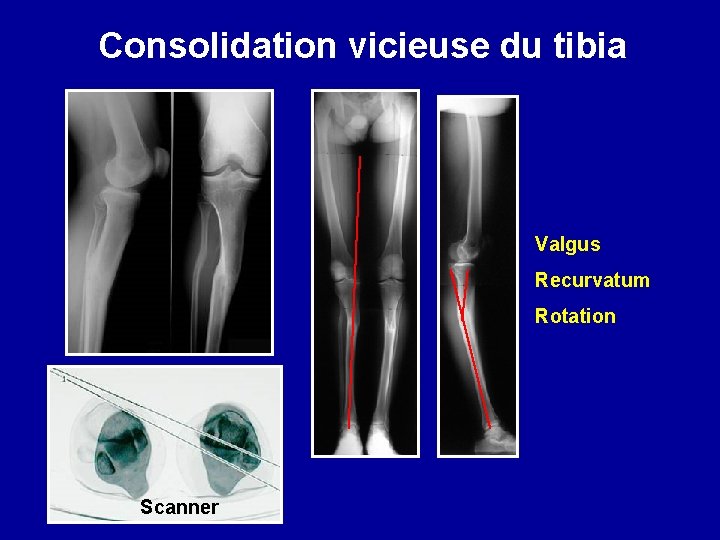 Consolidation vicieuse du tibia Valgus Recurvatum Rotation Scanner 