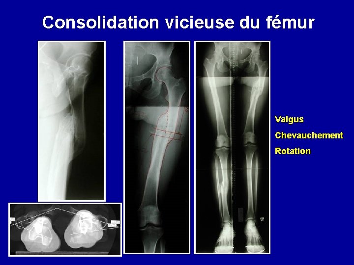 Consolidation vicieuse du fémur Valgus Chevauchement Rotation 