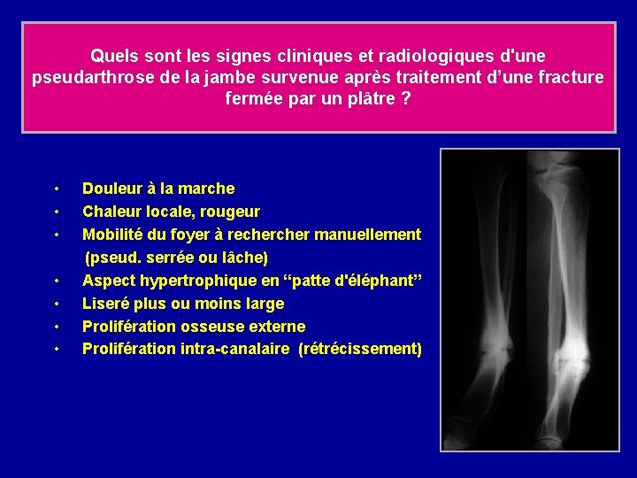 Quels sont les signes cliniques et radiologiques d'une pseudarthrose de la jambe survenue après