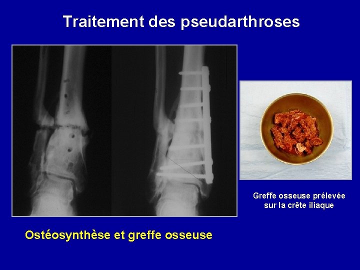 Traitement des pseudarthroses Greffe osseuse prélevée sur la crête iliaque Ostéosynthèse et greffe osseuse