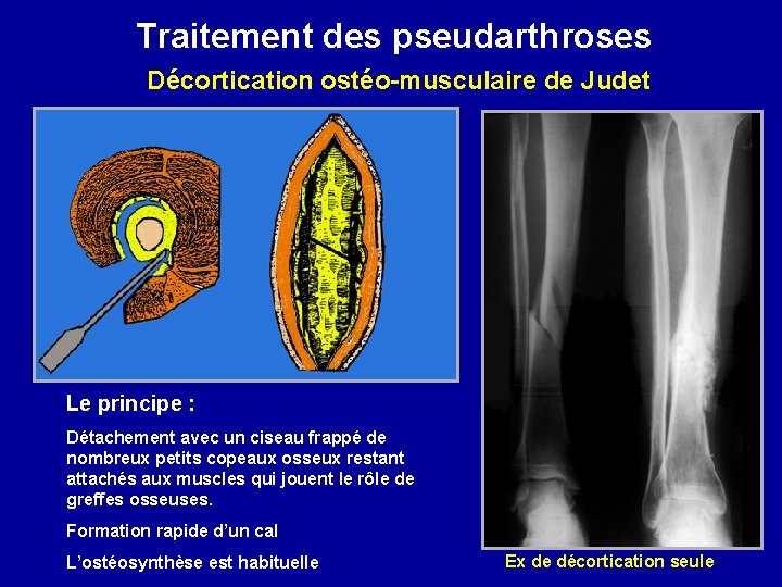 Traitement des pseudarthroses Décortication ostéo-musculaire de Judet Le principe : Détachement avec un ciseau