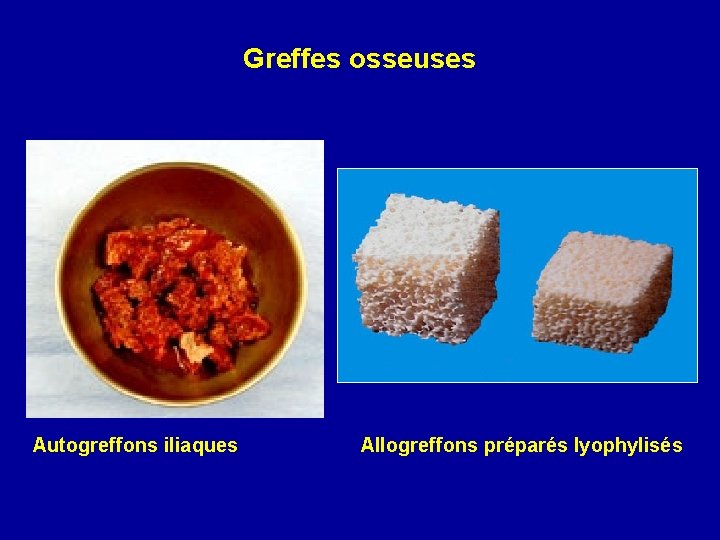 Greffes osseuses Autogreffons iliaques Allogreffons préparés lyophylisés 