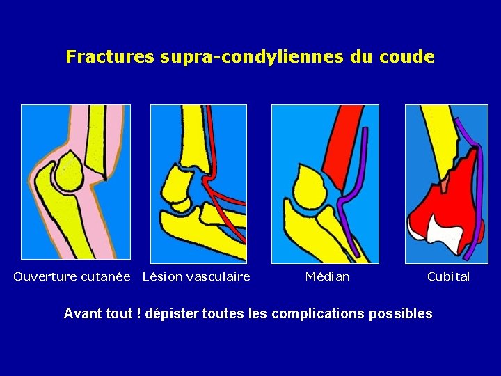 Fractures supra-condyliennes du coude Ouverture cutanée Lésion vasculaire Médian Cubital Avant tout ! dépister