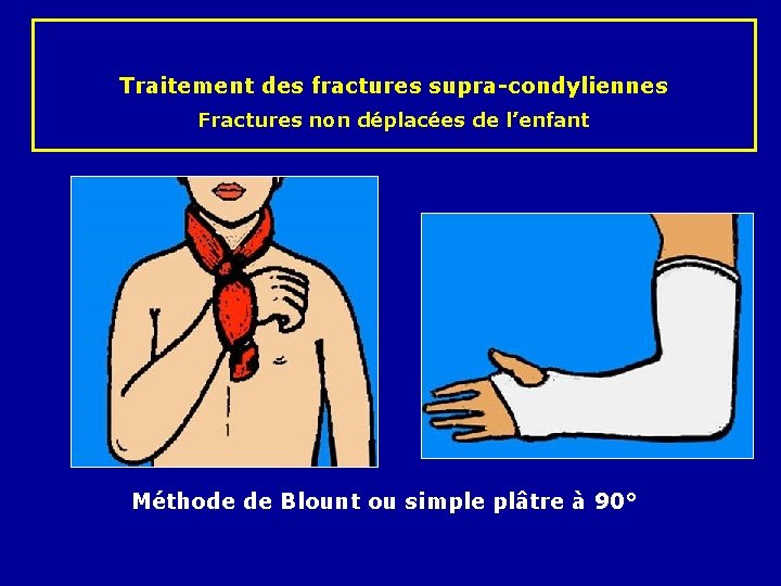 Traitement des fractures supra-condyliennes Fractures non déplacées de l’enfant Méthode de Blount ou simple