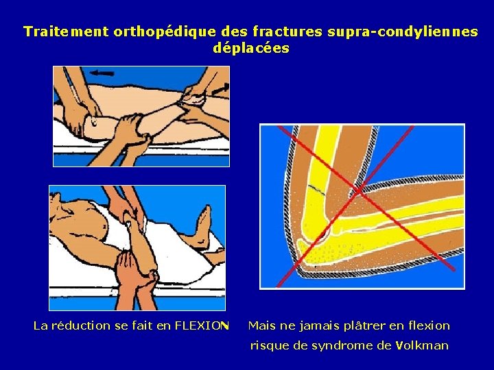 Traitement orthopédique des fractures supra-condyliennes déplacées La réduction se fait en FLEXION Mais ne