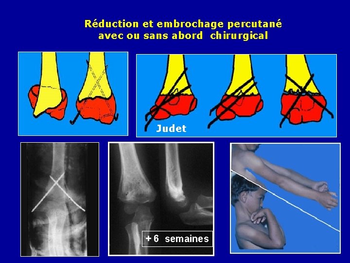 Réduction et embrochage percutané avec ou sans abord chirurgical Judet + 6 semaines 