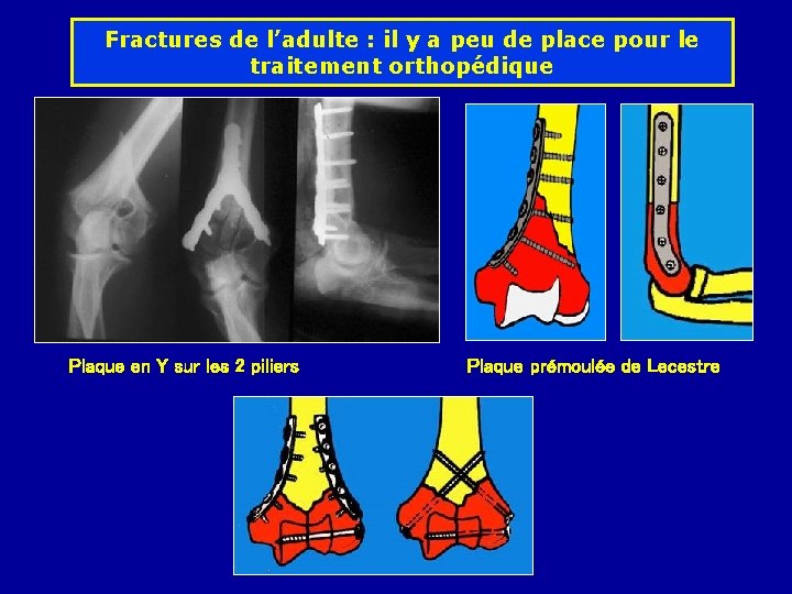 Fractures de l’adulte : il y a peu de place pour le traitement orthopédique