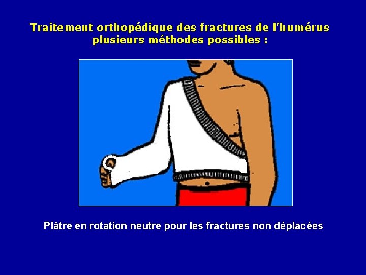 Traitement orthopédique des fractures de l’humérus plusieurs méthodes possibles : Plâtre en rotation neutre