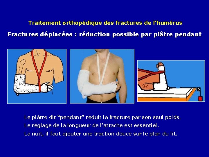 Traitement orthopédique des fractures de l’humérus Fractures déplacées : réduction possible par plâtre pendant