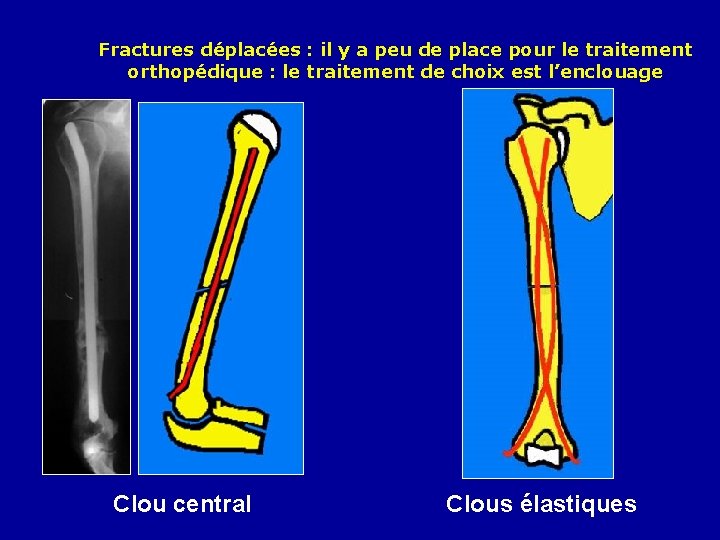Fractures déplacées : il y a peu de place pour le traitement orthopédique :