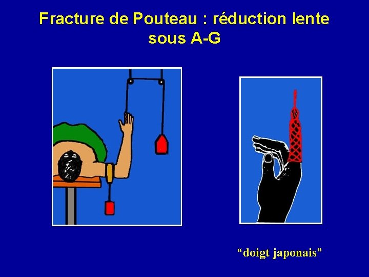 Fracture de Pouteau : réduction lente sous A-G “doigt japonais” 